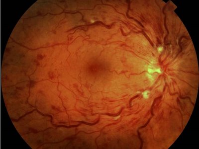 Angioma retinalne hipertenzije